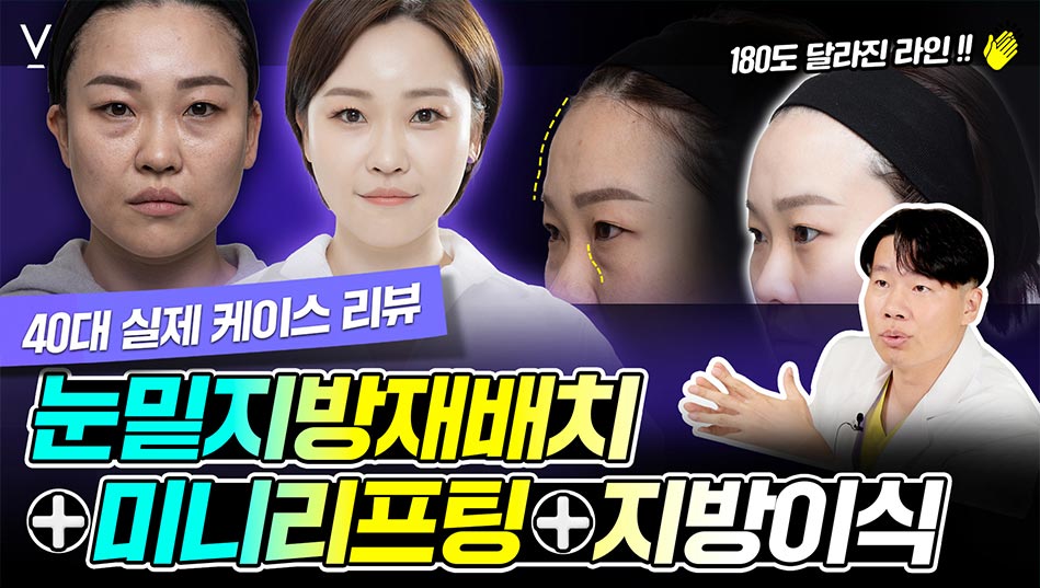 40대실제케이스리뷰