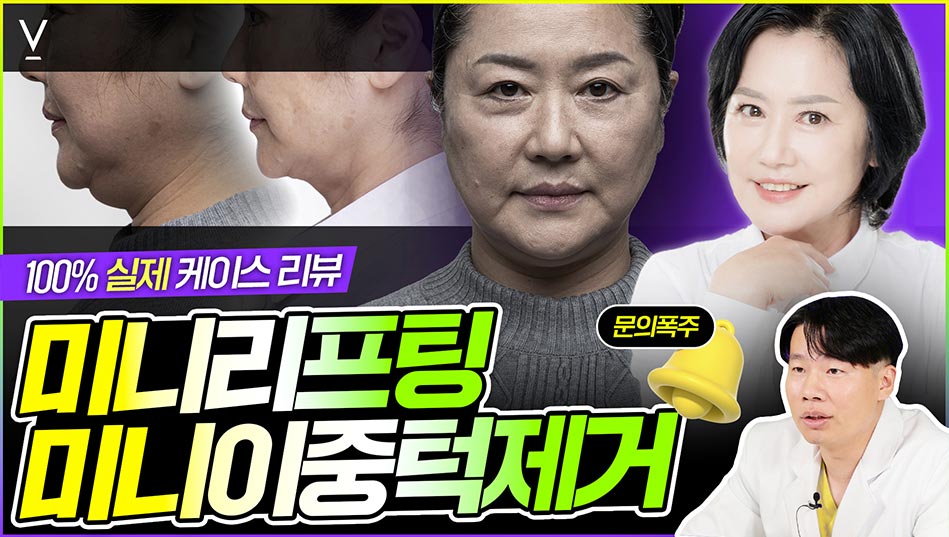 미니리프팅실제케이스리뷰