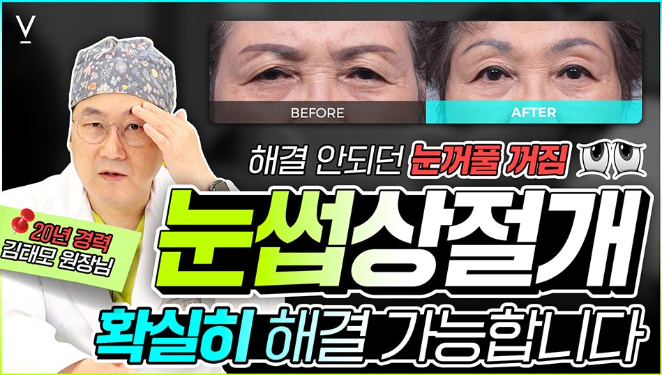 눈썹상절개