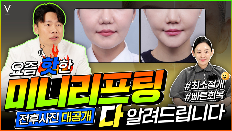 미니리프팅 전후사진대공개