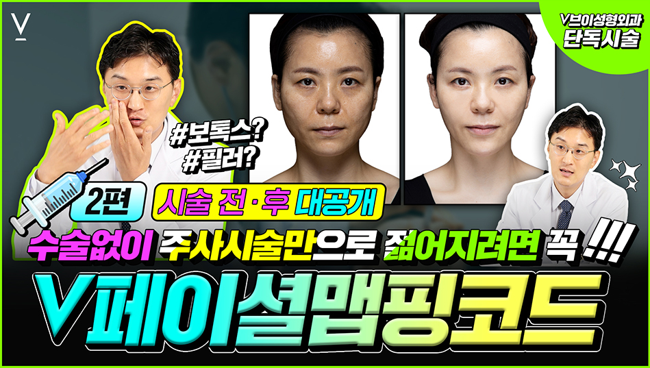 V페이셜맵핑코드 2편