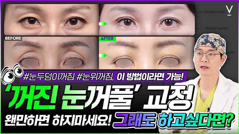 꺼진눈꺼풀 교정